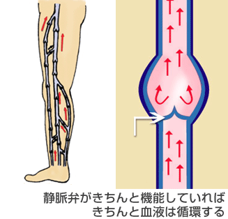 下肢静脈瘤は、静脈の弁が壊れる病気です。